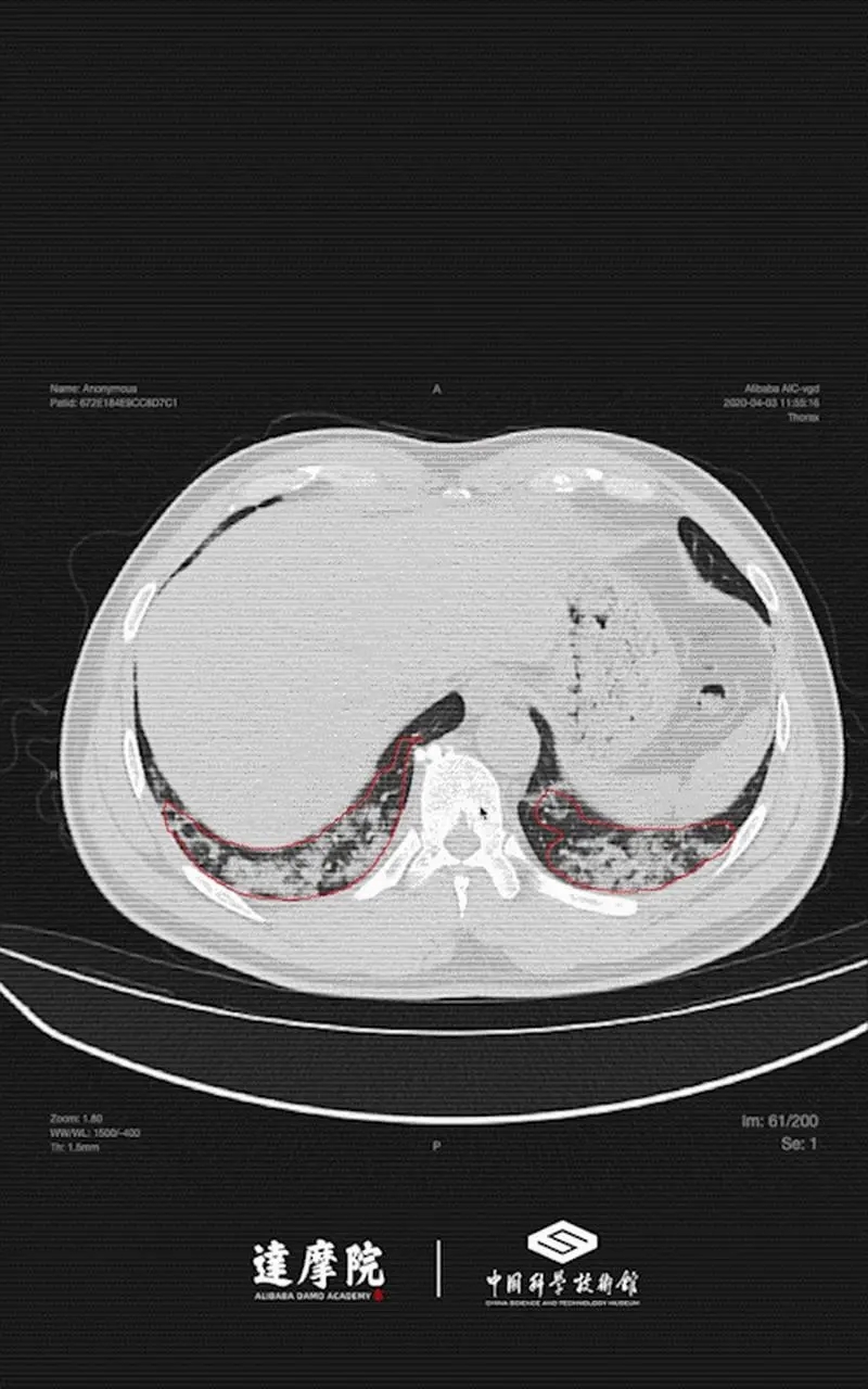 ai赋能医学影像,ct影像,达摩院ai抗疫